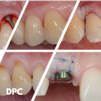Chirurgie plastique parodontale et péri-implantaire DPC 2026